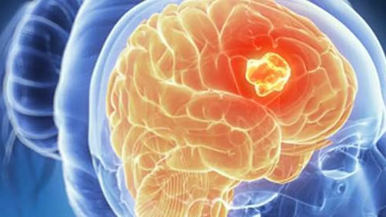 التنبؤ بشراسة الورم السرطاني يحدد مسار انتشار المرض بدقة باستخدام الذكاء الاصطناعي